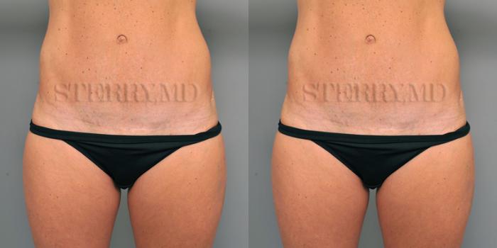 Before & After Tummy Tuck Case 212 View #4 View in New York, NY