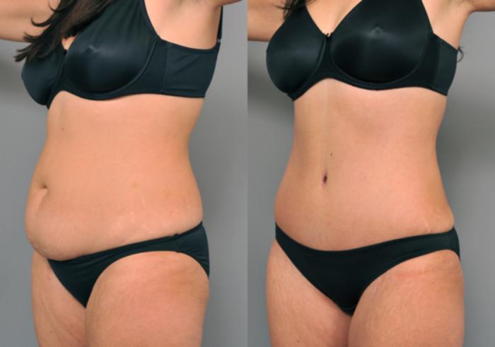 Before & After Tummy Tuck Case 213 View #1 View in New York, NY