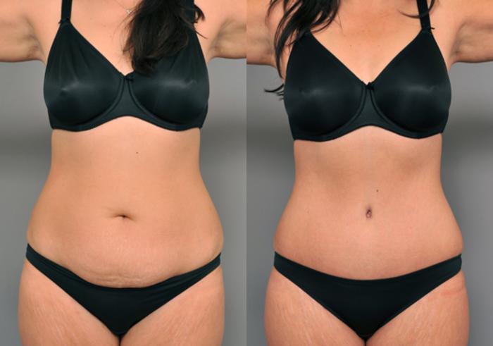 Before & After Tummy Tuck Case 213 View #2 View in New York, NY
