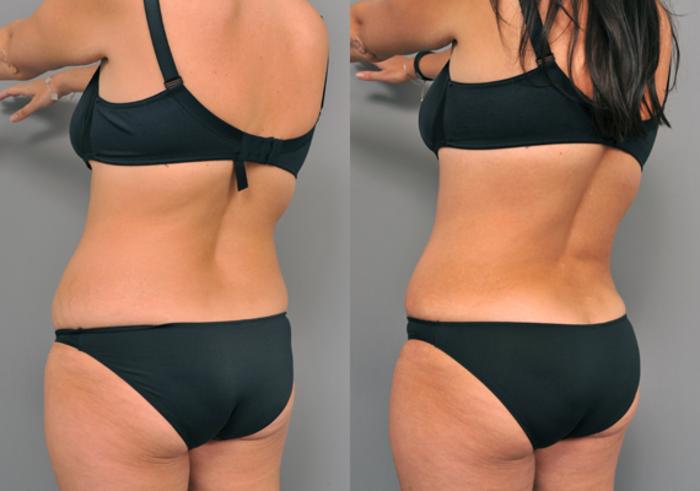 Before & After Tummy Tuck Case 213 View #3 View in New York, NY