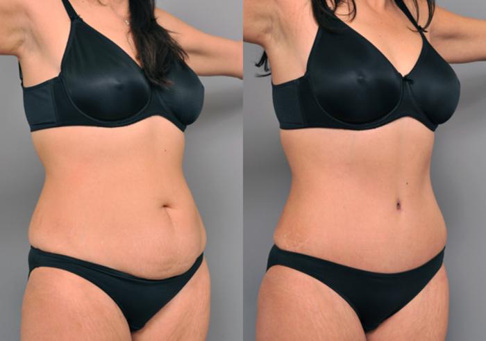 Before & After Tummy Tuck Case 213 View #4 View in New York, NY
