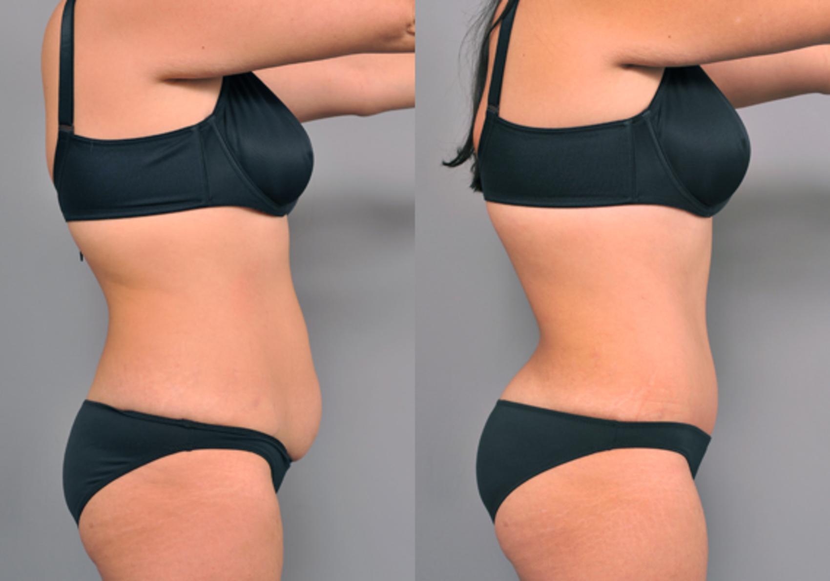 Before & After Tummy Tuck Case 213 View #5 View in New York, NY