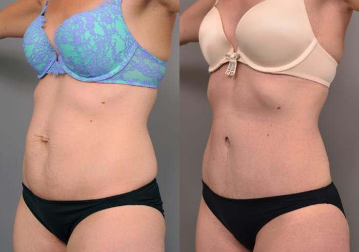 Before & After Tummy Tuck Case 218 View #1 View in New York, NY