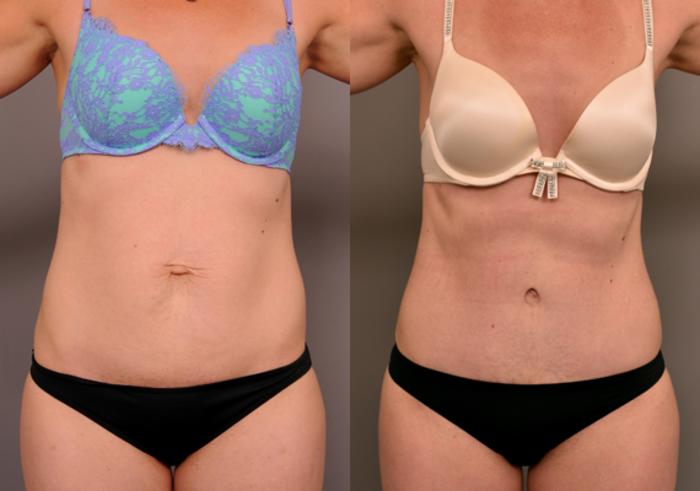Before & After Tummy Tuck Case 218 View #2 View in New York, NY