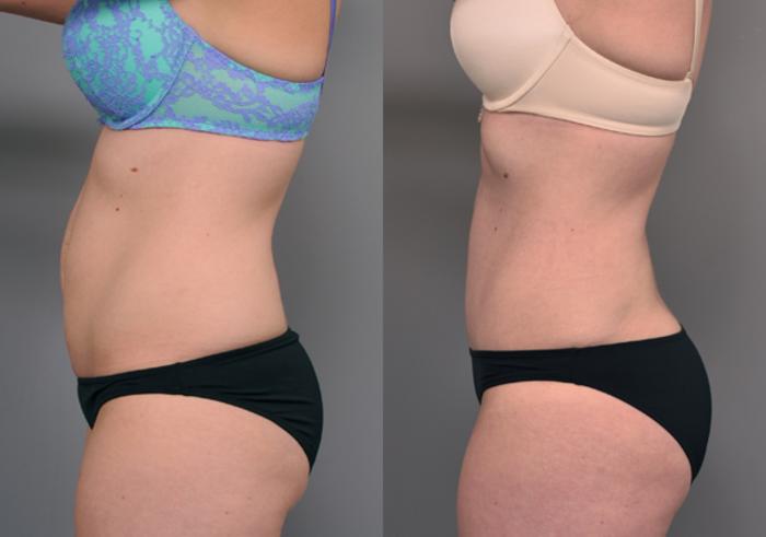 Before & After Tummy Tuck Case 218 View #3 View in New York, NY