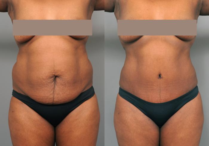 Before & After Tummy Tuck Case 219 View #1 View in New York, NY