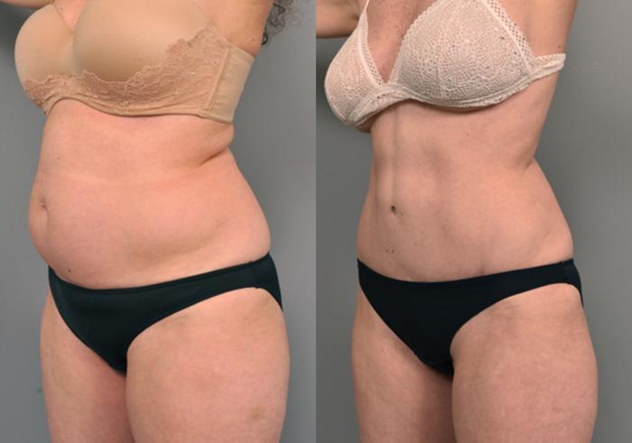 Before & After Tummy Tuck Case 221 View #1 View in New York, NY