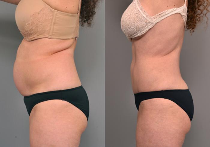Before & After Tummy Tuck Case 221 View #2 View in New York, NY