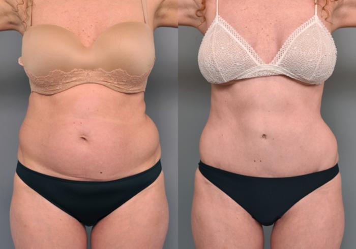 Before & After Tummy Tuck Case 221 View #3 View in New York, NY