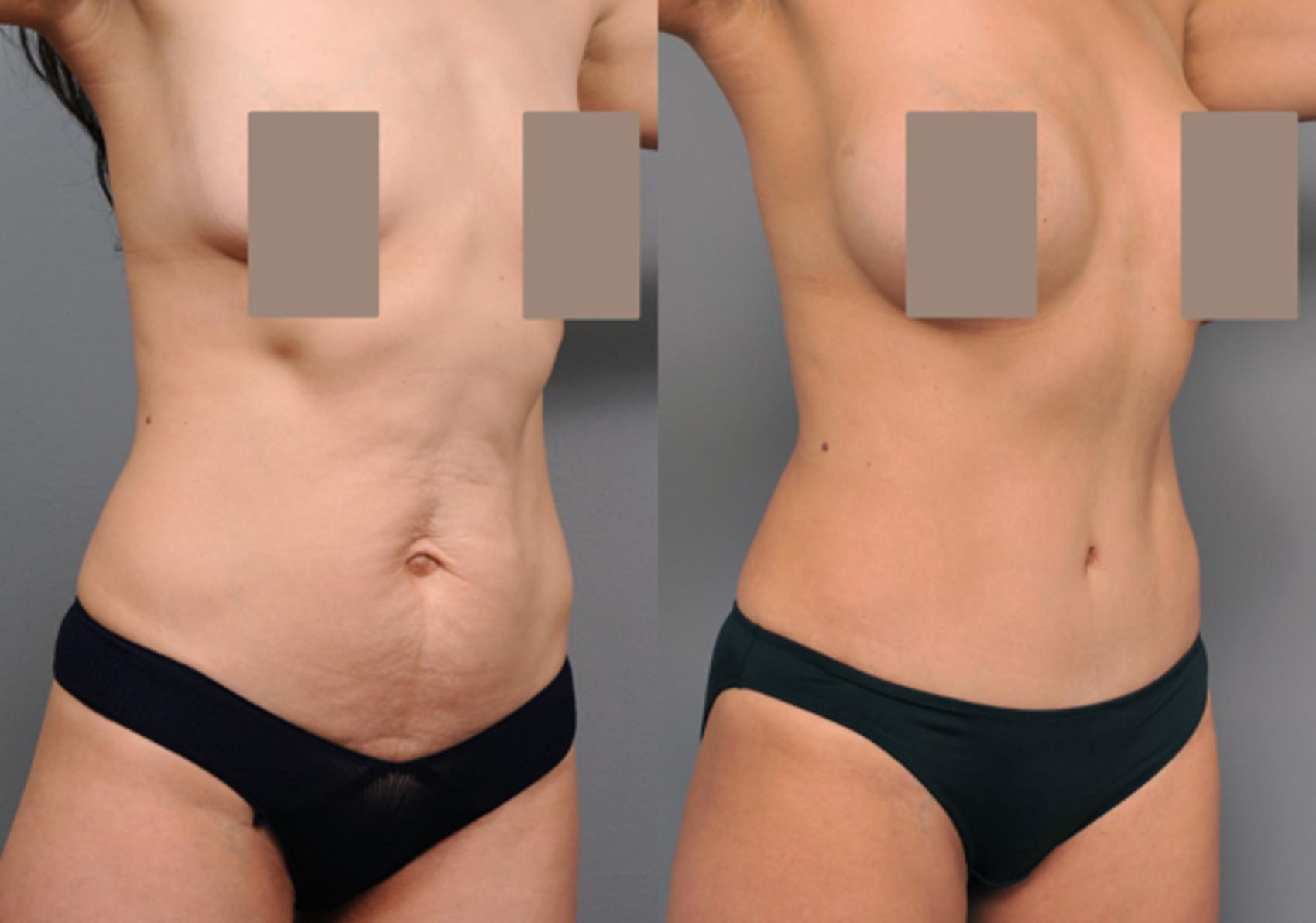 Full vs. Mini Tummy Tuck