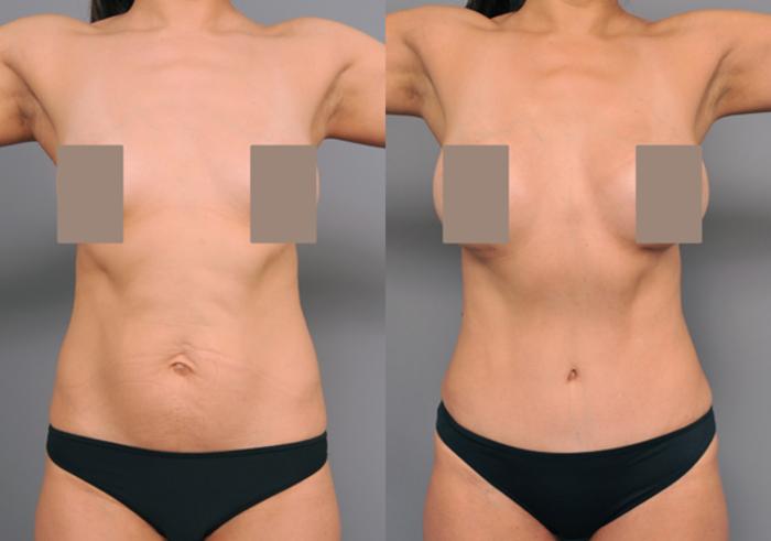 Before & After Tummy Tuck Case 223 View #2 View in New York, NY