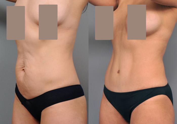 Before & After Tummy Tuck Case 223 View #3 View in New York, NY
