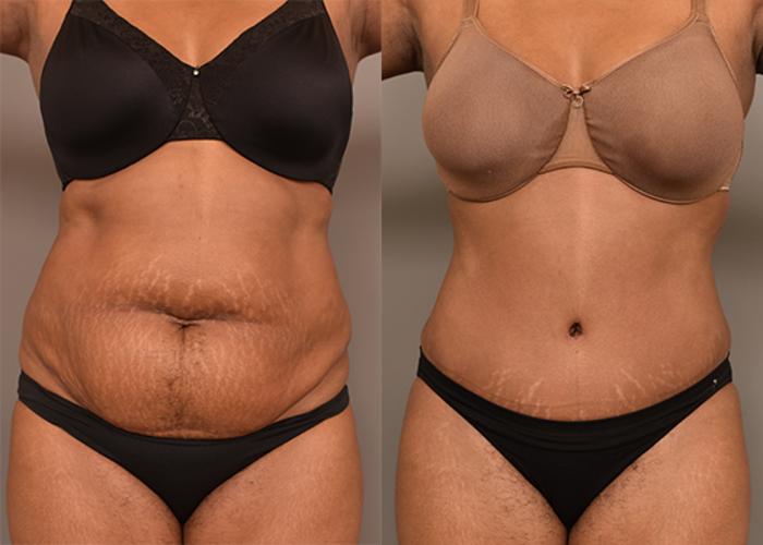 Before & After Tummy Tuck Case 231 View #1 View in New York, NY