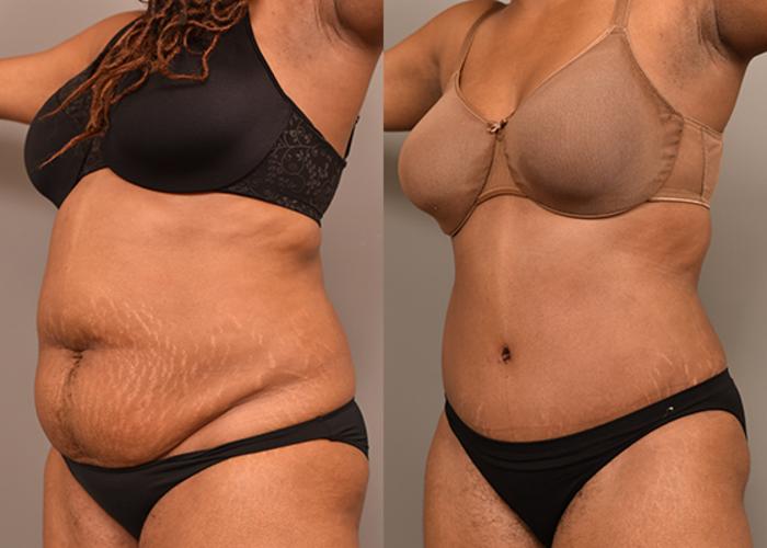 Before & After Tummy Tuck Case 231 View #2 View in New York, NY