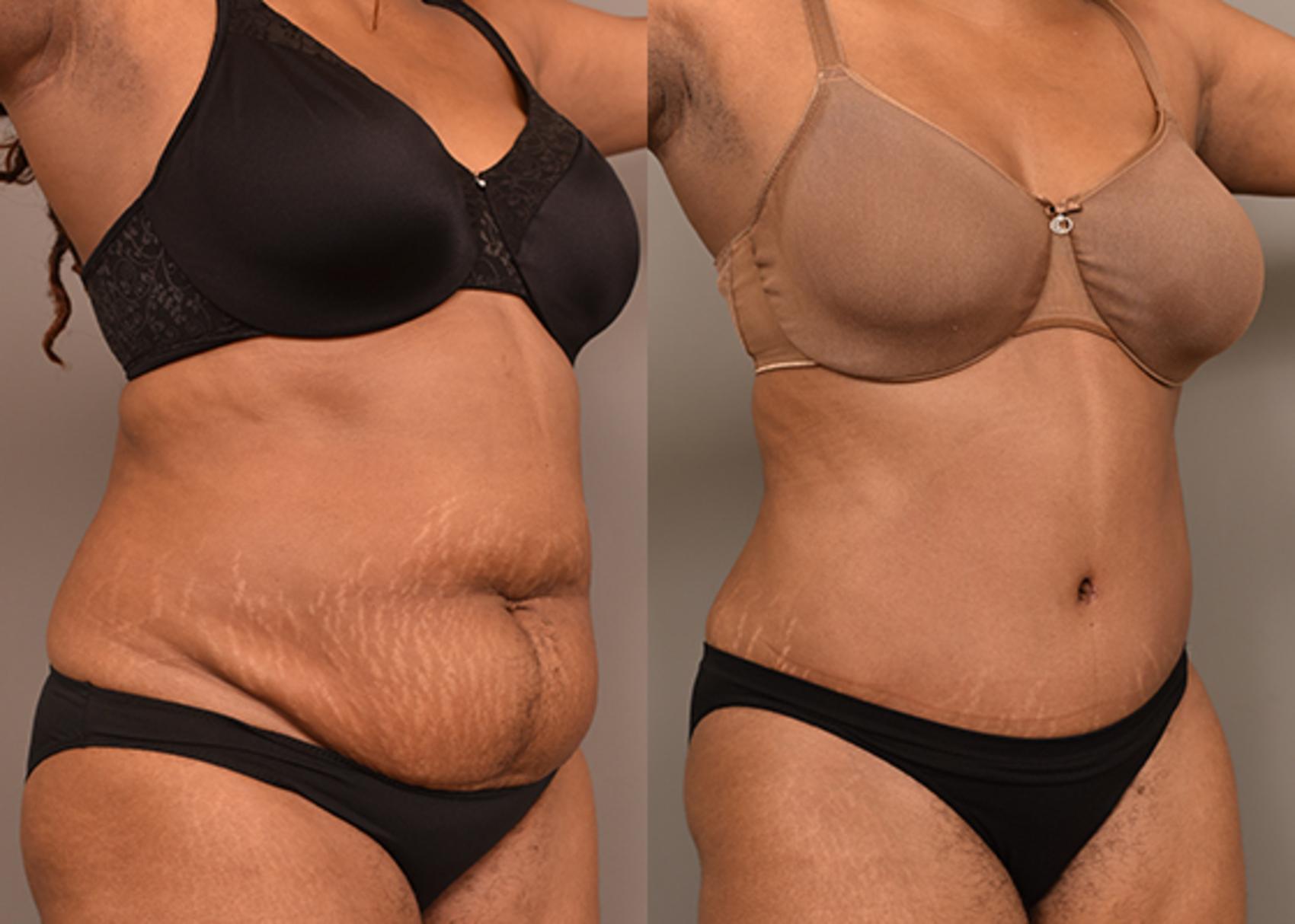 Before & After Tummy Tuck Case 231 View #3 View in New York, NY