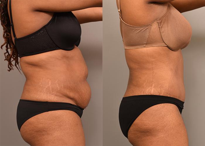 Before & After Tummy Tuck Case 231 View #4 View in New York, NY