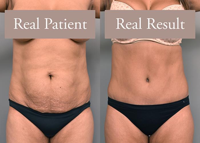 Before & After Tummy Tuck Case 234 View #1 View in New York, NY
