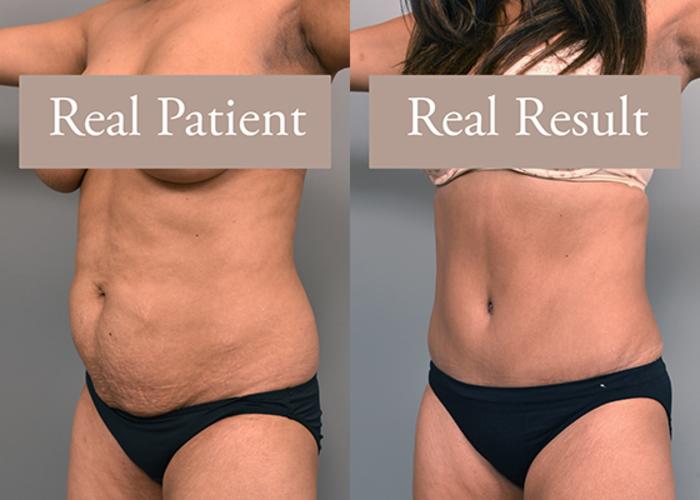 Before & After Tummy Tuck Case 234 View #2 View in New York, NY
