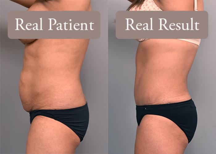 Before & After Tummy Tuck Case 234 View #3 View in New York, NY