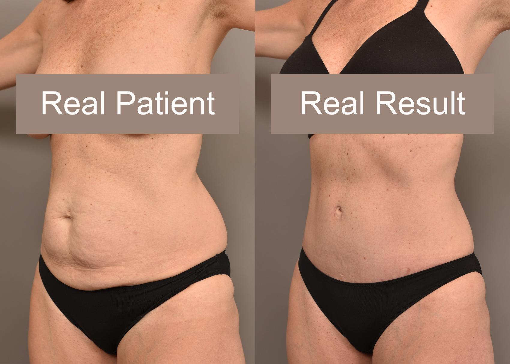 Before & After Tummy Tuck Case 235 View #1 View in New York, NY