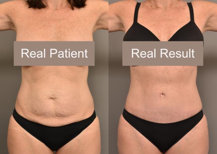 Before & After Tummy Tuck Case 235 View #2 View in New York, NY
