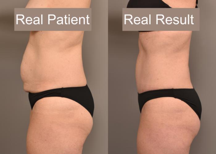 Before & After Tummy Tuck Case 235 View #3 View in New York, NY