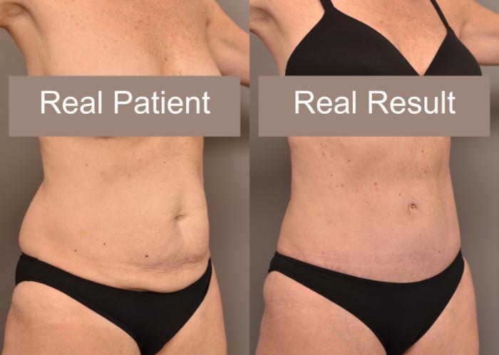 Before & After Tummy Tuck Case 235 View #4 View in New York, NY