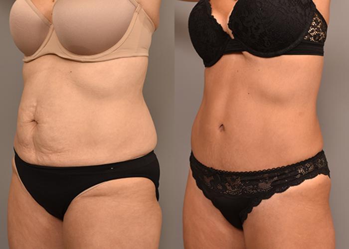 Before & After Tummy Tuck Case 246 View #1 View in New York, NY