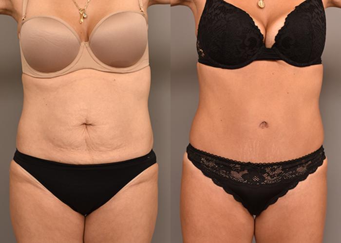 Before & After Tummy Tuck Case 246 View #2 View in New York, NY