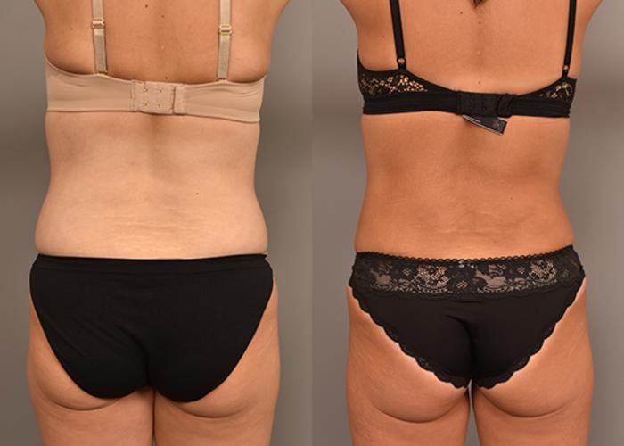 Before & After Tummy Tuck Case 246 View #3 View in New York, NY