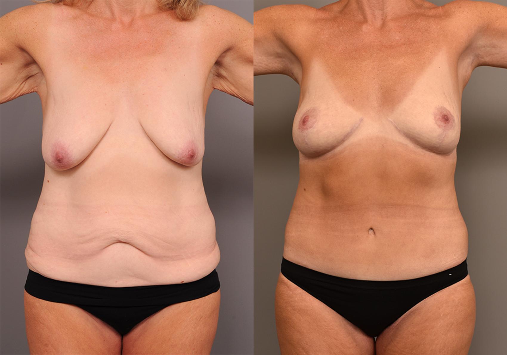 Before & After Tummy Tuck Case 248 View #1 View in New York, NY