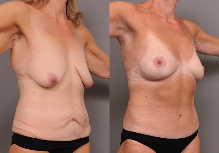Before & After Tummy Tuck Case 248 View #2 View in New York, NY