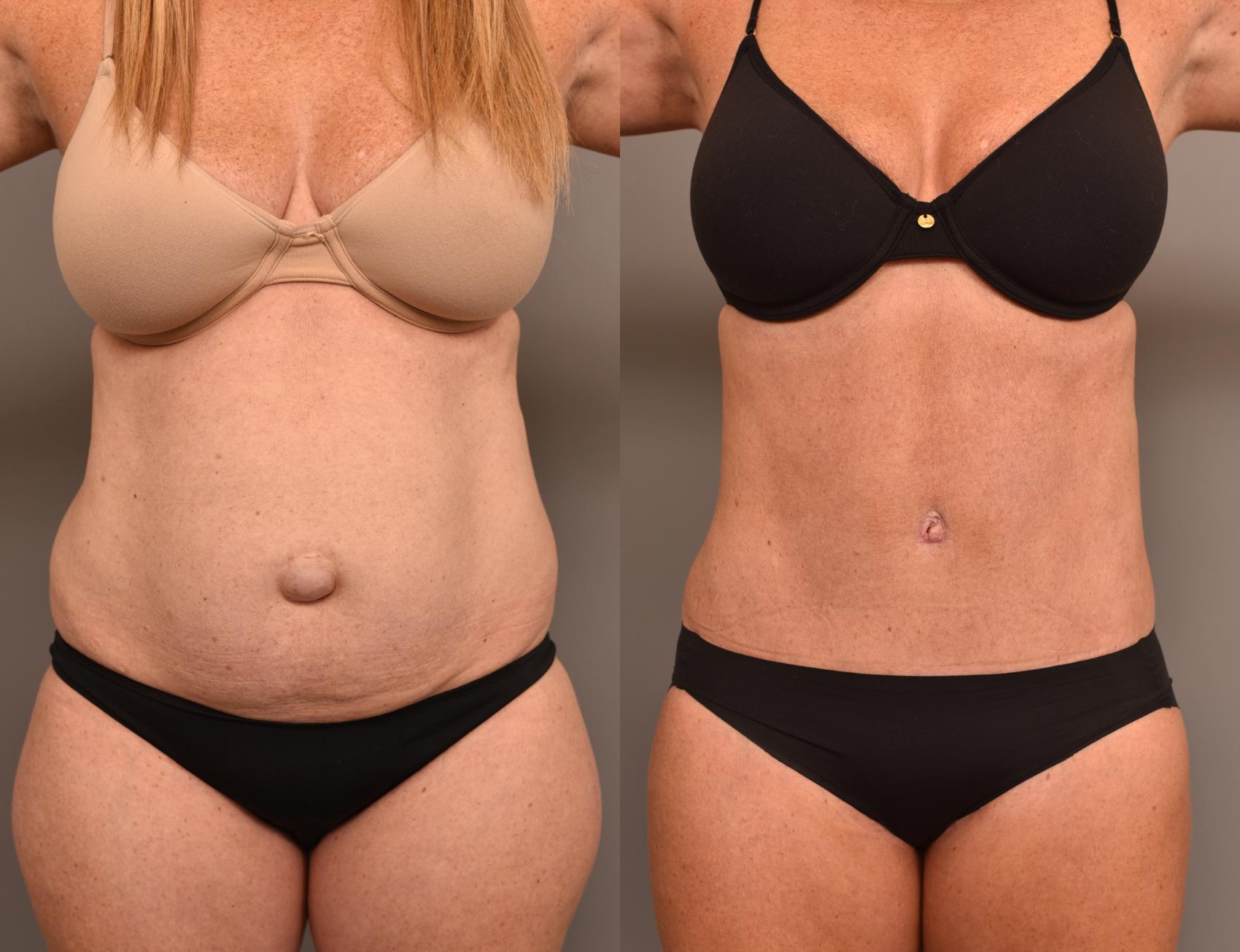 Body Contouring Along With Hernia Repair