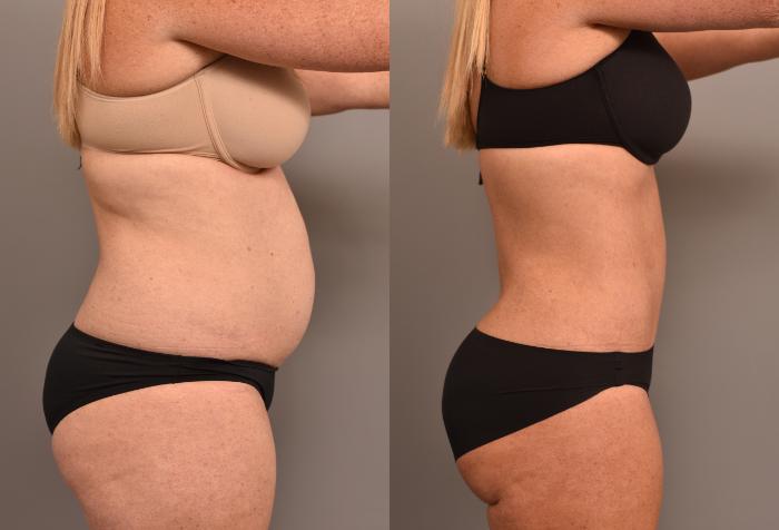 Before & After Tummy Tuck Case 249 View #2 View in New York, NY