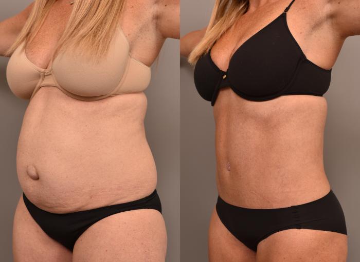 Before & After Tummy Tuck Case 249 View #3 View in New York, NY