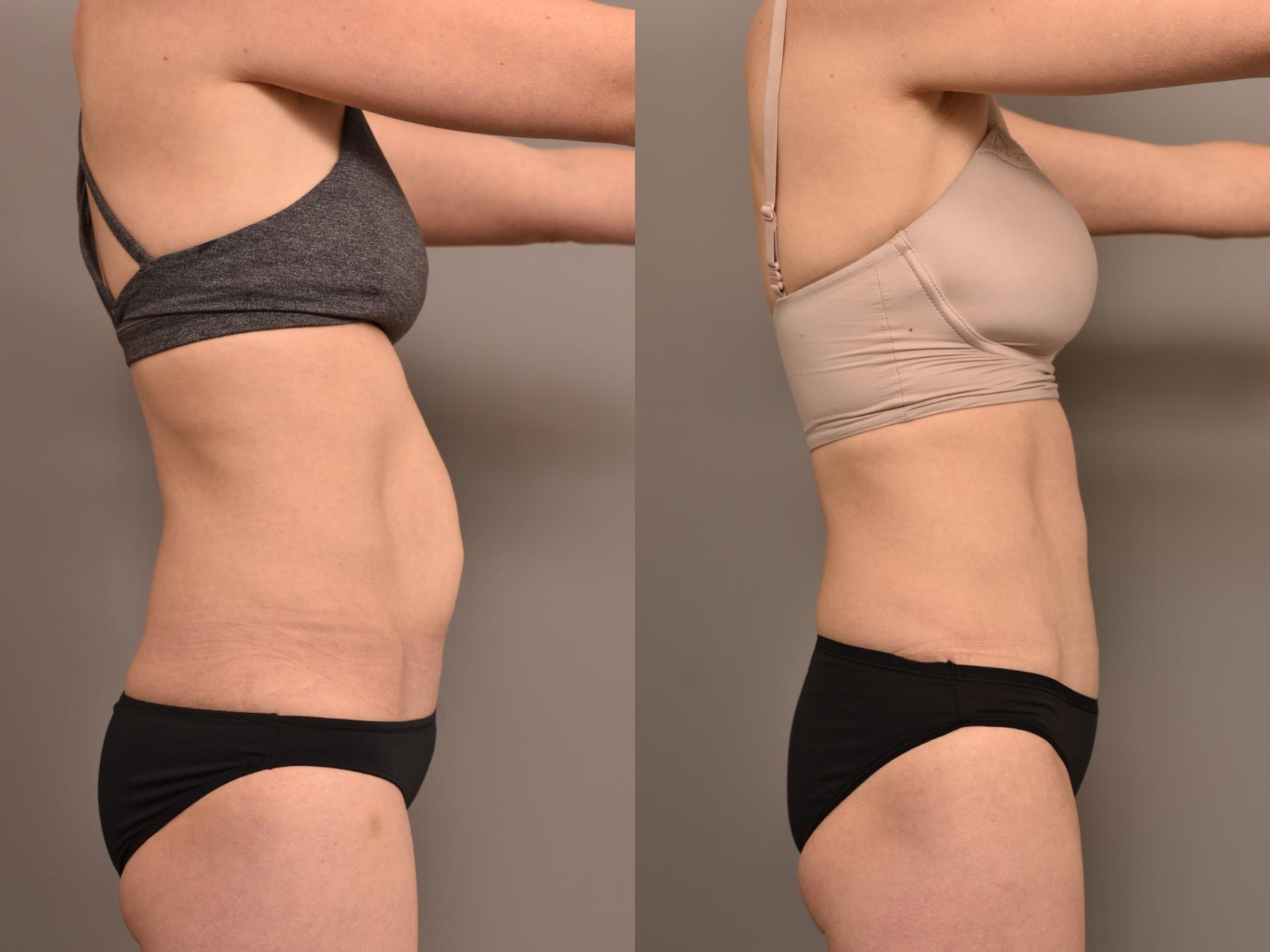Before & After Tummy Tuck Case 265 Right Side View in New York, NY