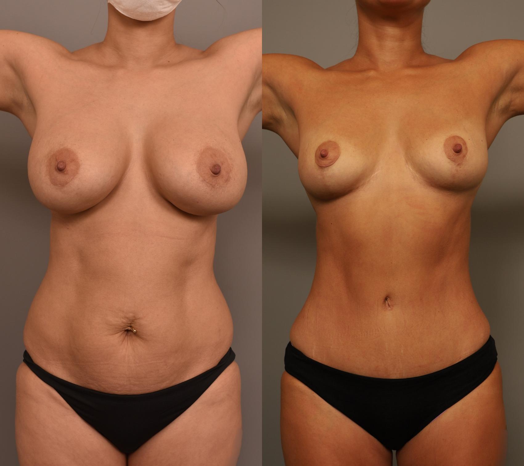 A front profile of a female patient shown in two images: one before and one after undergoing liposuction.