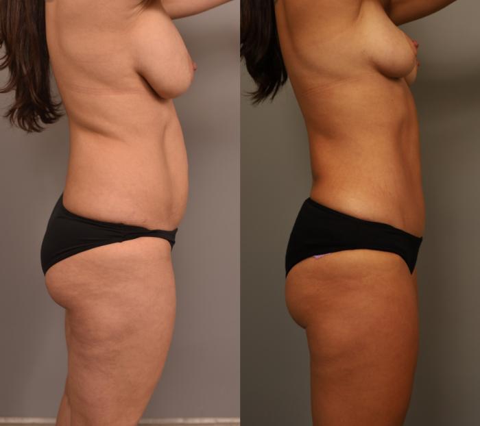 Before & After Liposuction Case 272 Left Side View in New York, NY