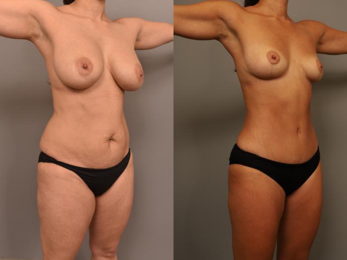 Before & After Liposuction Case 272 Right Oblique View in New York, NY