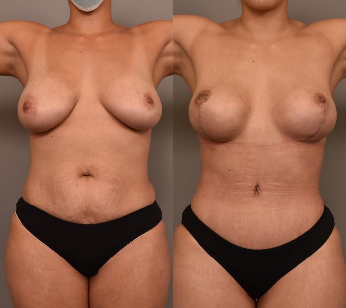 A female patient shown in two images: one before and one after undergoing a tummy tuck, breast augmentation and liposuction of the flanks.