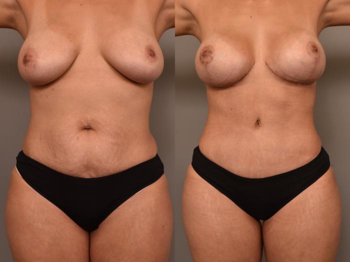 Before & After Breast Augmentation Case 274 Front View in New York, NY