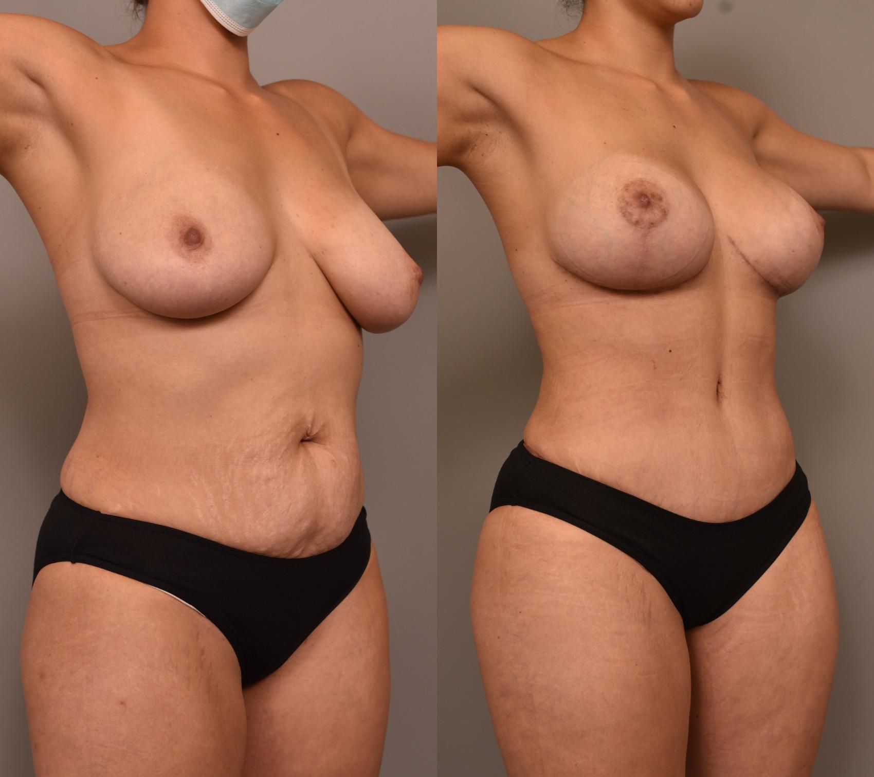 A female patient shown in two images: one before and one after undergoing a tummy tuck, breast augmentation and liposuction of the flanks