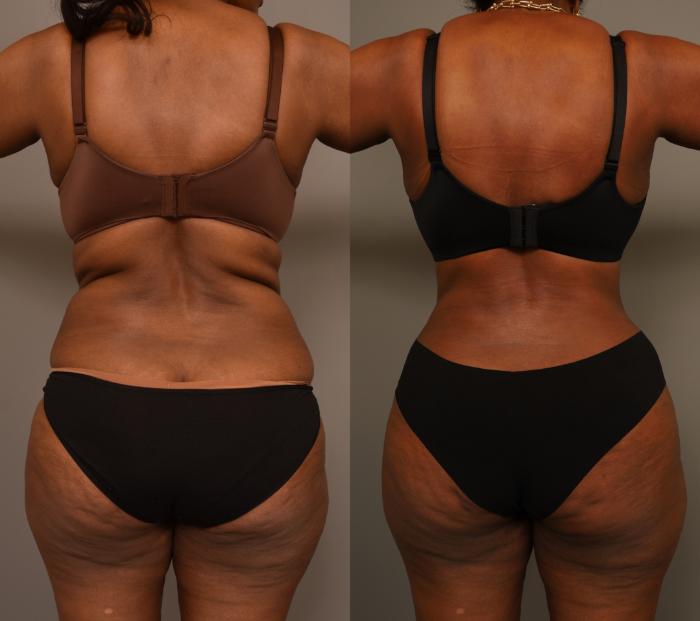 Before & After Tummy Tuck Case 280 Back View in New York, NY