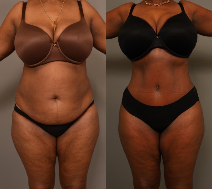 Before & After Tummy Tuck Case 280 Front View in New York, NY