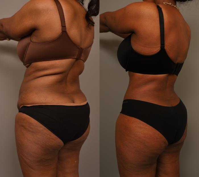 Before & After Tummy Tuck Case 280 Left Posterior Oblique View in New York, NY