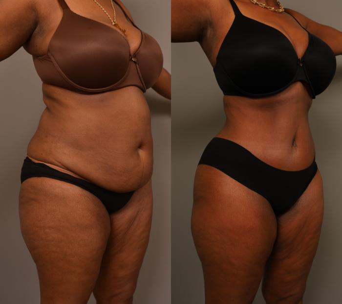 Before & After Tummy Tuck Case 280 Right Oblique View in New York, NY