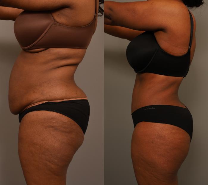 Before & After Tummy Tuck Case 280 Right Side View in New York, NY