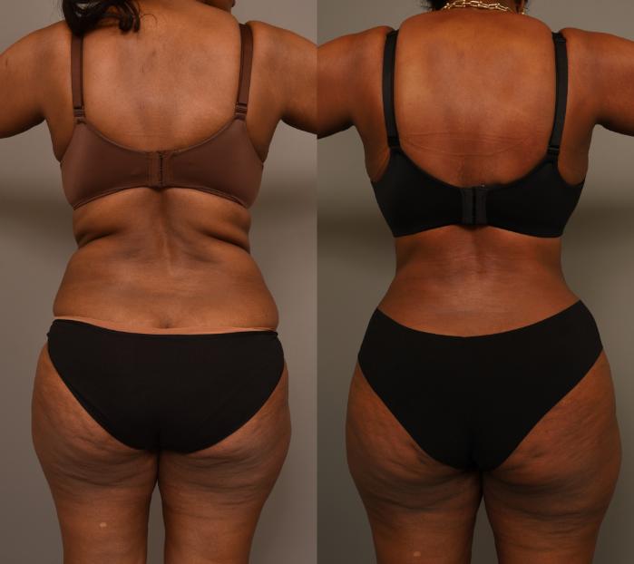 Before & After Tummy Tuck Case 281 Back View in New York, NY