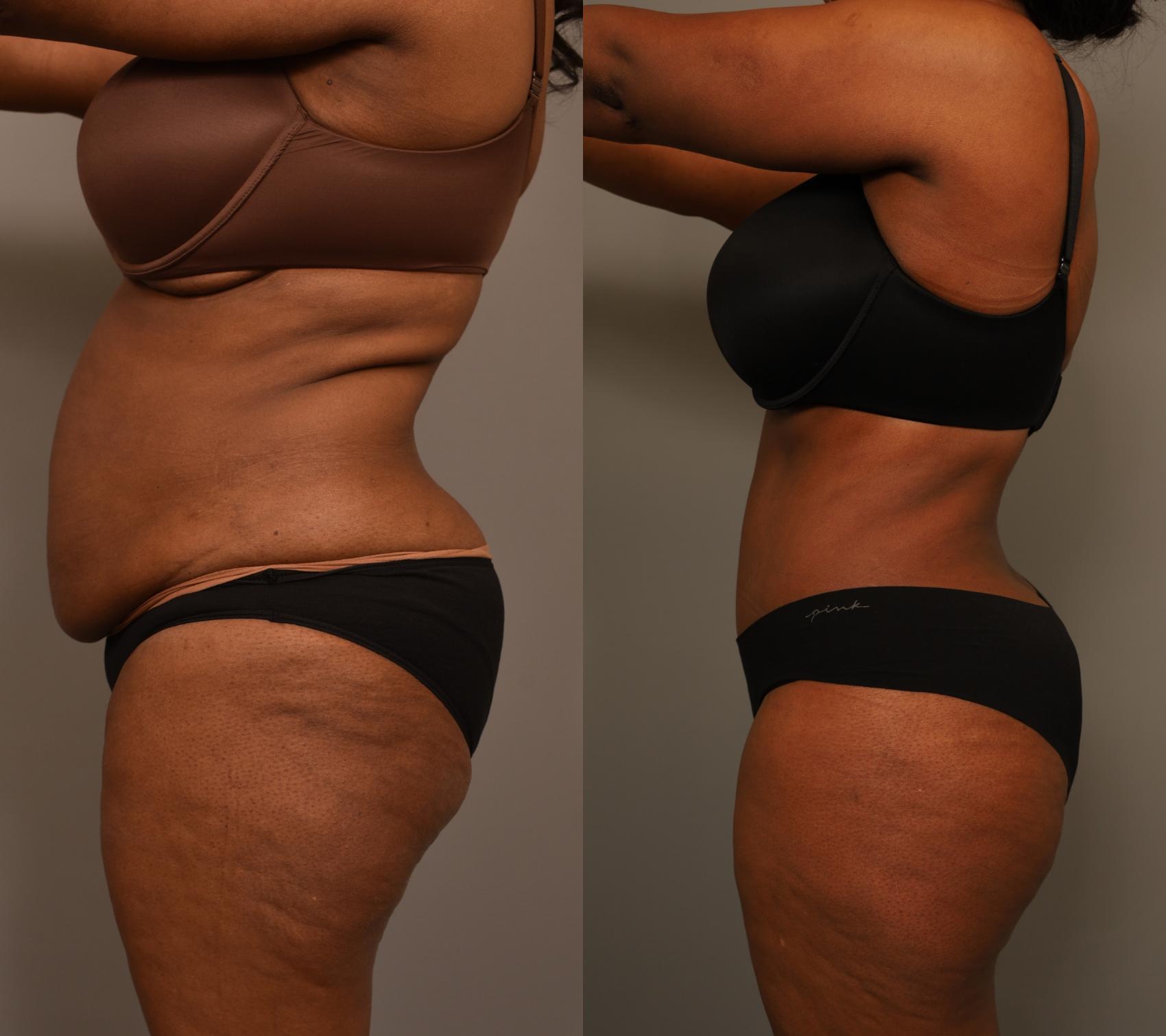 Before & After Tummy Tuck Case 283 Right Side View in New York, NY