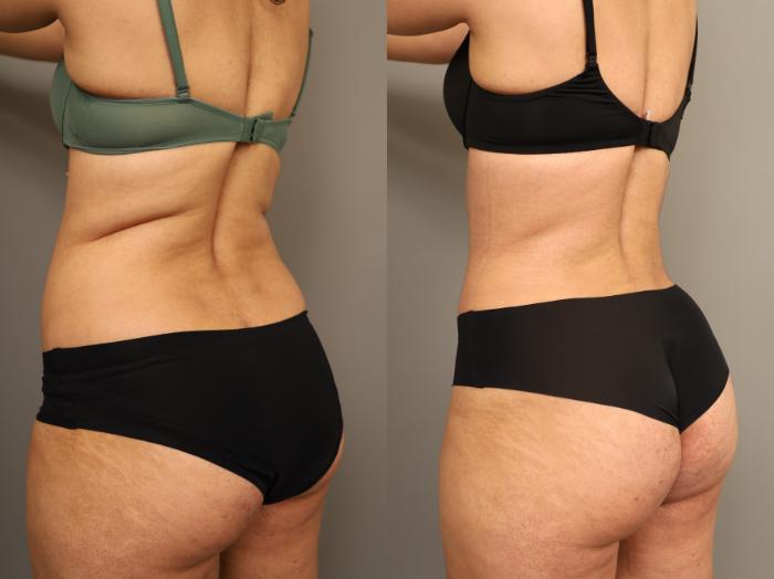 Before & After Tummy Tuck Case 324 Back View in New York, NY